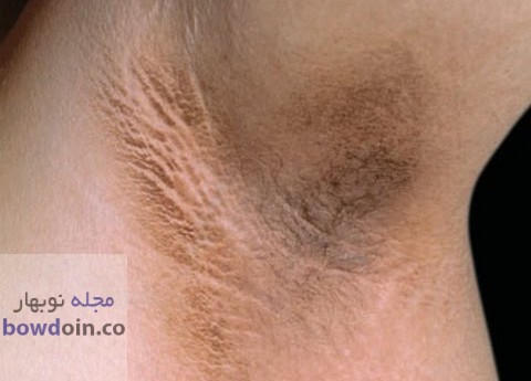 علل تیرگی زیر بغل